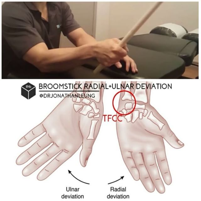 A common climbing problem is pain on the inside portion of the wrist.  Sometimes this pain can be a result to damage to the red circle - or TFCC, which is a cartilage structure on the pinky finger side of the wrist.  It&;s function is to support and cushion the small bones of the wrist and stabilize the bones of the forearm (radius and ulna) when the hand grasps or the forearm rotates. It&;s important to strengthen the wrist in more than just flexion and extension.  When doing this exercise you are working your wrist using radial and ulnar deviation.  Keep in mind the following:Stabilize the forearmSmooth, steady controlled motionGrab closer to the CENTER of the stick for an EASIER exercise Grab closer to the END of the stick for a HARDER exercise Rinse and repeat 20 times as part of your warm up or for sets as an integral part of wrist maintenance                    series