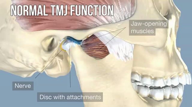 If you&;ve got ringing in the ears (tinnitus), headaches or neck pain that won&;t seem to go away even with treatment? Did you know your jaw could be the cause?--------------------Now that you understand some of the basic movements of the jaw - we&;ll go into a little more detail about how the TMJ functions as a whole.  The two smooth movements the TMJ have are:Rotation TranslationHere you will see how it works in motion - Jaw opening - During the first bit of jaw opening there is just pure rotation, and then as the jaw opens wider, the articular disc moves and there is a translation component.  This video here demonstrates normal TMJ function. .Do you have a click? .If everything is moving well - you will have a smooth motion.  If not, you may have a bit of a click or a pop and this is the articular disc getting displaced or pinned during this TRANSLATION phase of movement and then suddenly popping or snapping into place.  Note that this processed is reversed on jaw closing and allows another opportunity for displacement or dysfunction to arise with the disc. .                          series