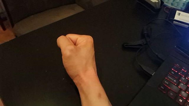 Day . Painful pronation and supination at end range. Rehab :HourlyROM circular articular rotations within painfree rangesqueeze grip x30flex/Ext stretching pnf30s deadhangs (80% bw) End range pain 6/10Turning car keys =0 pain Turning wheel =3/10