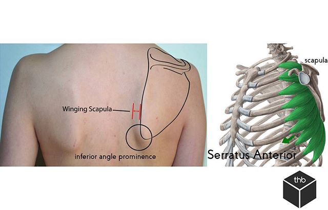 A Winging scapula is a result of weakness of the Serratus Anterior muscle or damage to the long thoracic nerve which supplies this muscle. The result is a protruding shoulder blade into the back.Test yourself - While wearing a tank top:Put yourself in a pushup position against the wallLean forward into your handsAsk somebody to take a picture for you.Do you notice a bump on one side versus the other?If you don&;t have a friend - go into the washroom and take a look at your shoulder heights.Do you notice one shoulder significantly lower than the other?If you do. You have scapular winging.  This can affect your ability to lift, pull, or push objects.  The reason is because scapular winging is a muscular imbalance which results in malpositioning of the shoulder blade.  This disrupts the Scapulohumeral rhythm - which is the optimal ratio of movement when you lift your arm from your side above your head.  If this is a result from a long thoracic nn entrapment Active Release Therapy or ART can definitely help with this nervous entrapment. Proper positioning and movement of the scapula is critical for full and normal shoulder range of motion. Without it, your scapular is SICK! (Scapular malposition, Inferior medial border prominence, Coracoid pain and malposition, and dysKinesis of scapular movement) SICK scapula or scapular dyskinesis refers to an injury resulting from overuse and fatigue of the muscles that stabilize and provide motion for the scapula.To counteract it we want to:. Treat the underlying soft tissue adhesionsStrengthen the affected musclesGrease the groove and provide stimuli to maintain the positioning and movement of the scapula