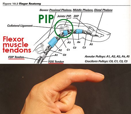 The finger is comprised of a number of joints, muscles, tendons, and many pulleys!Visualized here is your index finger! In the next posts we will will focus on 3  things: Flexor tendonsAnnular pulleysProximal Interphalangeal joint (PIP)There are many other components to the finger that are important to climbing. Injuries to these areas such as the joint capsules of each phalanx, each knuckle (capsule tissue injuries/capsulitis), the lumbrical muscles (another finger muscle injury source!) and the volar plates. (super super important for ADOLESCENT climbers! Attn:  coaches) stay tuned.