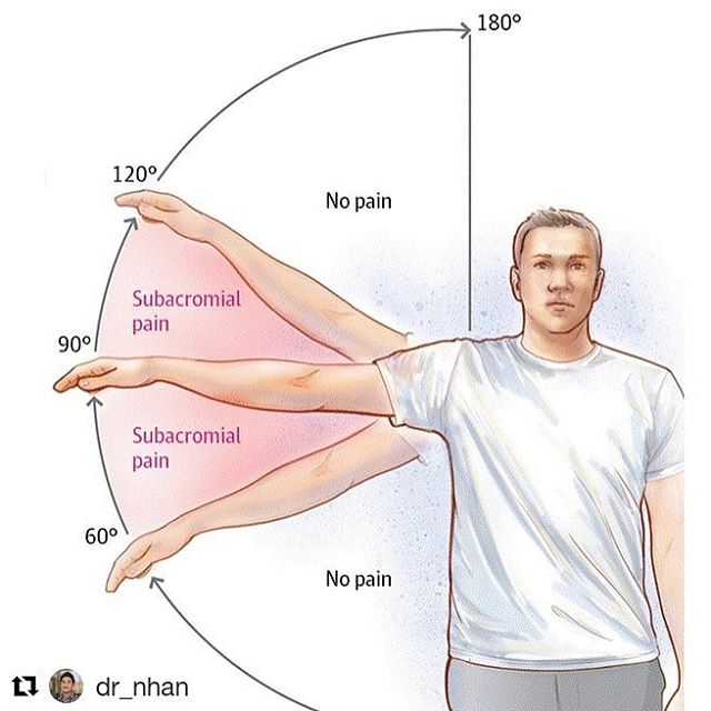 @dr_nhan (@get_repost)・・・Shoulder Impingement Syndrome (aka Subacromial Impingment): one of the most common conditions I see that result in shoulder pain. Most patients will complain of pain near the front or side of the shoulder with very particular arm movements, usually involving flexion and/or abduction of the glenohumeral joint along with certain degrees of internal and external rotation. Some may experience referral pain on the side of the arm or even down near the elbow, thinking it&;s elbow pain.Anatomically, when the arm is lifted into these painful ranges, the structures between the humerus and acromion (what we call the subacromial space) have the potential to get pinched. These structures may include the supraspinatus tendon, biceps tendon, subacromial bursa, and subscapularis tendon. The reason this pinch occurs is most commonly due to less than optimal biomechanical movement - the most common being scapular instability, scapular dyskinesis, and poor rotator cuff engagement or sequencing. Hence, if you attempt to move the shoulder without proper shoulder stability or muscle firing patterns, the humerus can ride up too close to the acromion which causes the structures in the subacromial space to pinch underneath the acromion. Thus, to mend these issues one must train the muscles that stabilize the scapula and the rotator cuffs muscles to function appropriately. My shoulder protocol of choice for these cases involve training the serratus anterior with high plank protractions, rhomboids with rows, subscapularis with internal rotations, infraspinatus and teres minor with external rotations, and posterior deltoid with horizontal abductions. You can refer to the last four exercise videos on this page for demos on variations of these exercises. This protocol is also a great prehab warm up routine that I personally use before my upper body days in the gym, which can help PREVENT shoulder impingement from even occurring. Feel the gains to prevent the pain