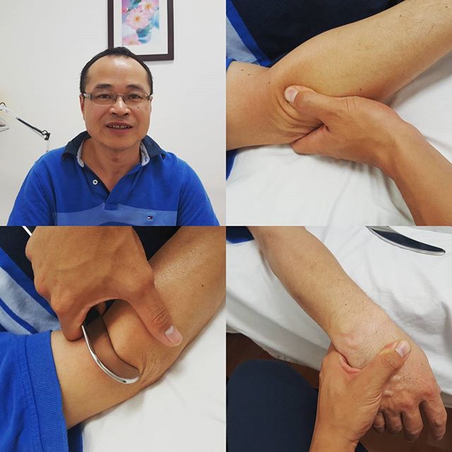 Patient of mine working as a machine operator with tennis elbow or lateral epicondylitis on BOTH arms!Treated him using  Instrument Assisted Soft Tissue ARTWrist and elbow magicEccentric exerciseThis is the best  I could ask for from this fine gentleman.Some of you climbers and dodgeballers get some of this elbow pain. Check yourself before you wreck yourself.